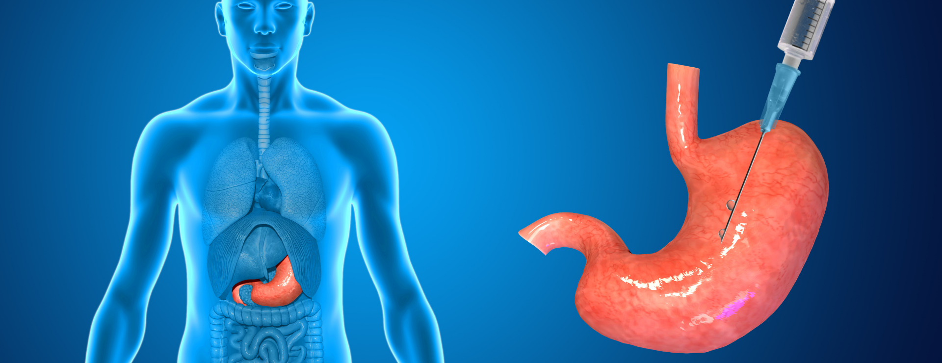 Gastric Reduction