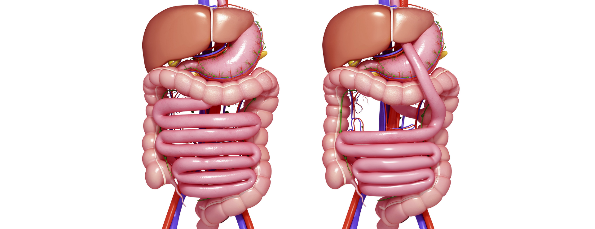 Gastric Bypass