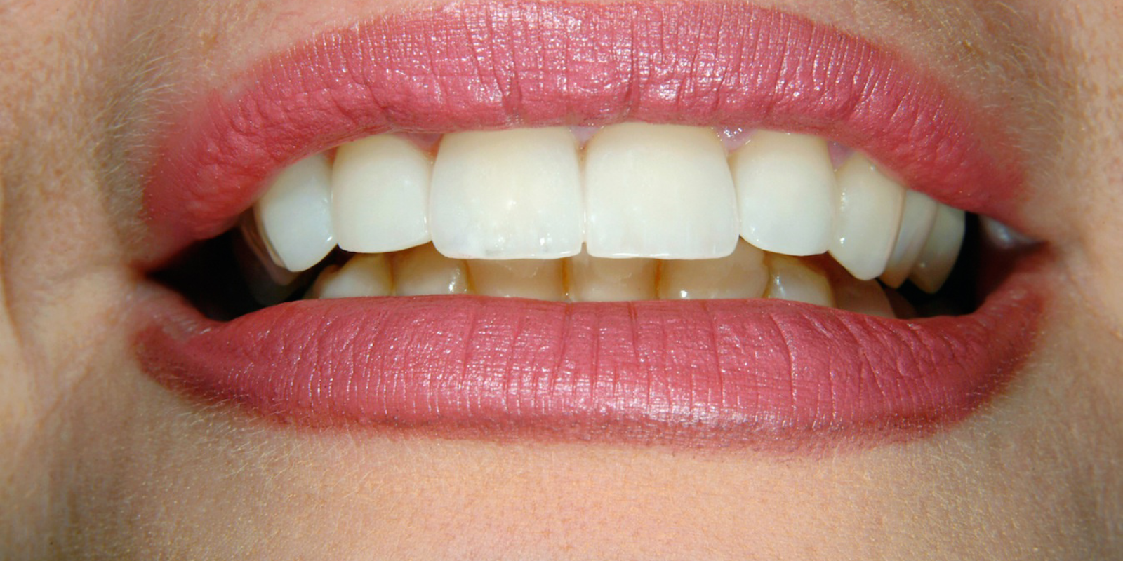 Smile Design